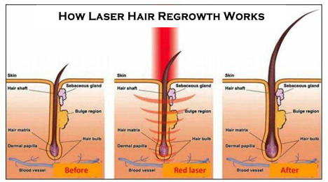Low-level light therapy and hair loss - researchgate.net